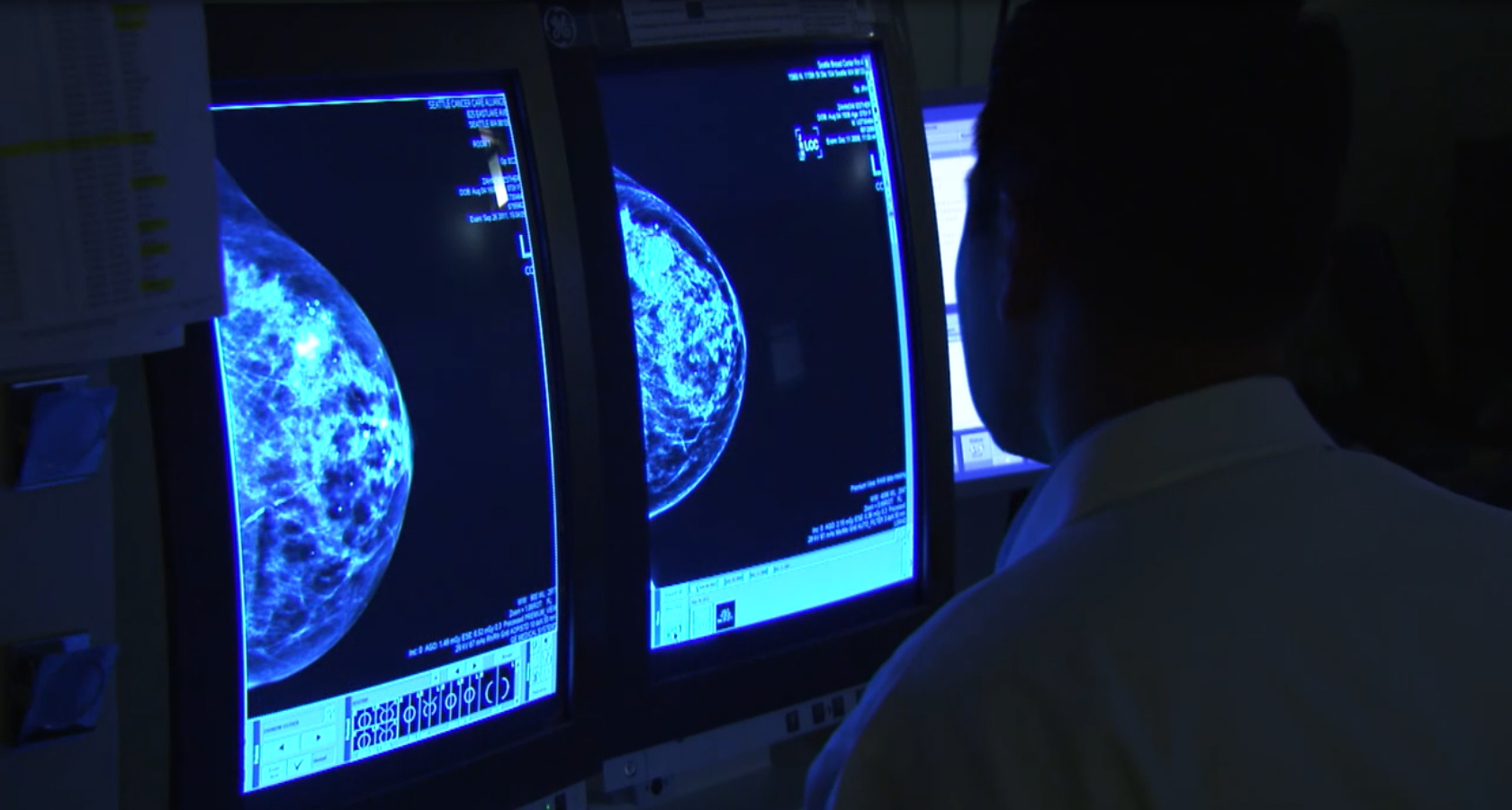 When Should You Get a Mammogram?