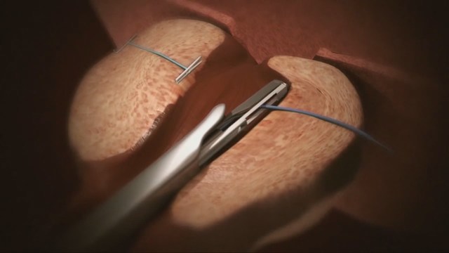 New Procedure For Enlarged Prostate