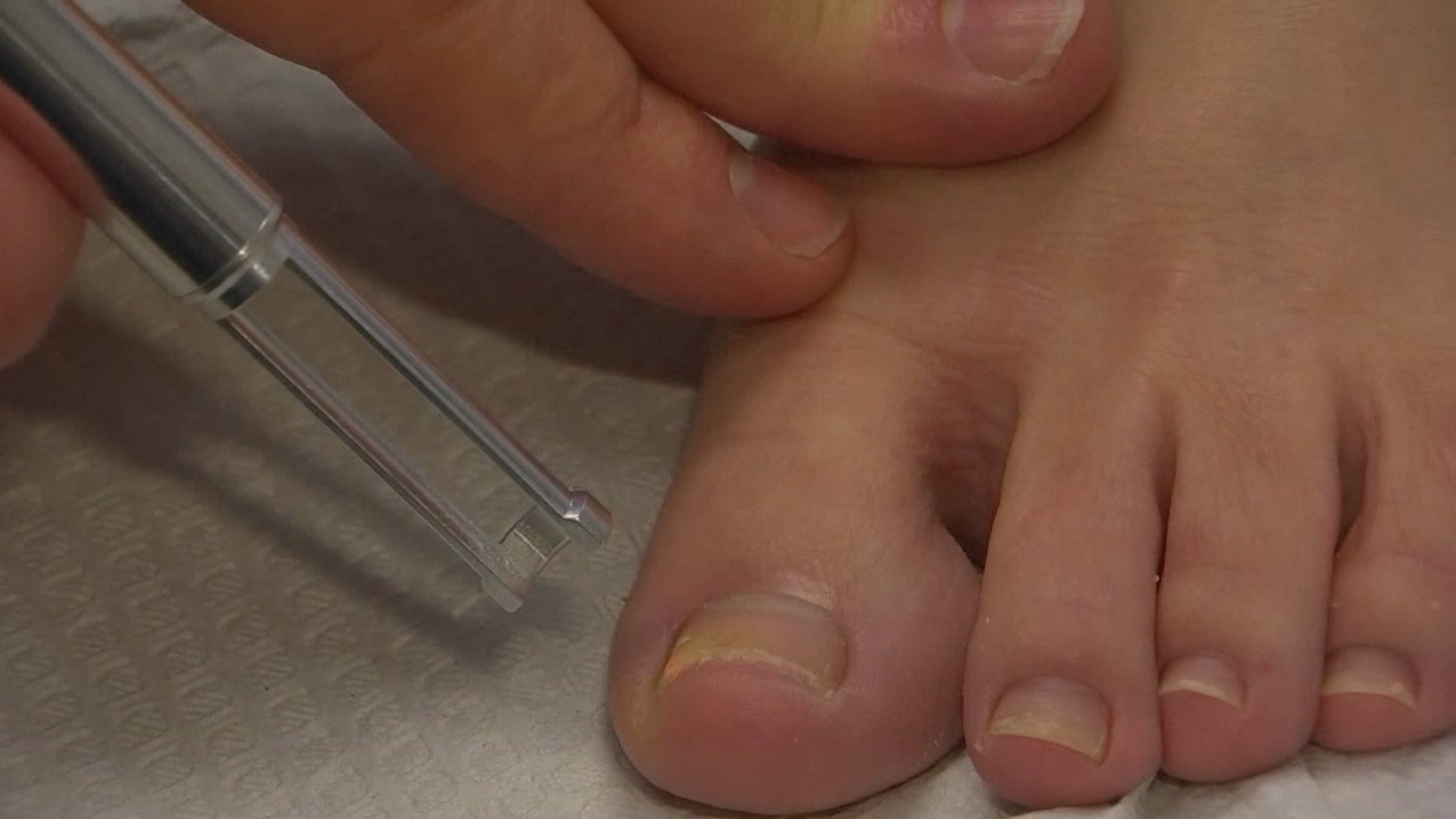 Killing toenail fungus with laser treatment 